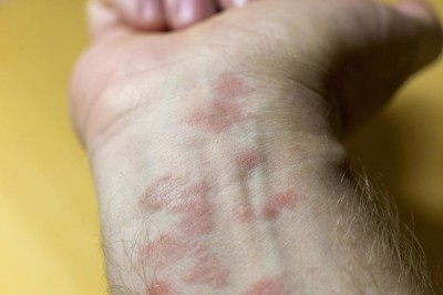 Giải pháp hỗ trợ điều trị bệnh eczema hiệu quả nhờ sản phẩm thảo dược